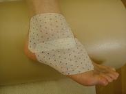 足首の捻挫の治療