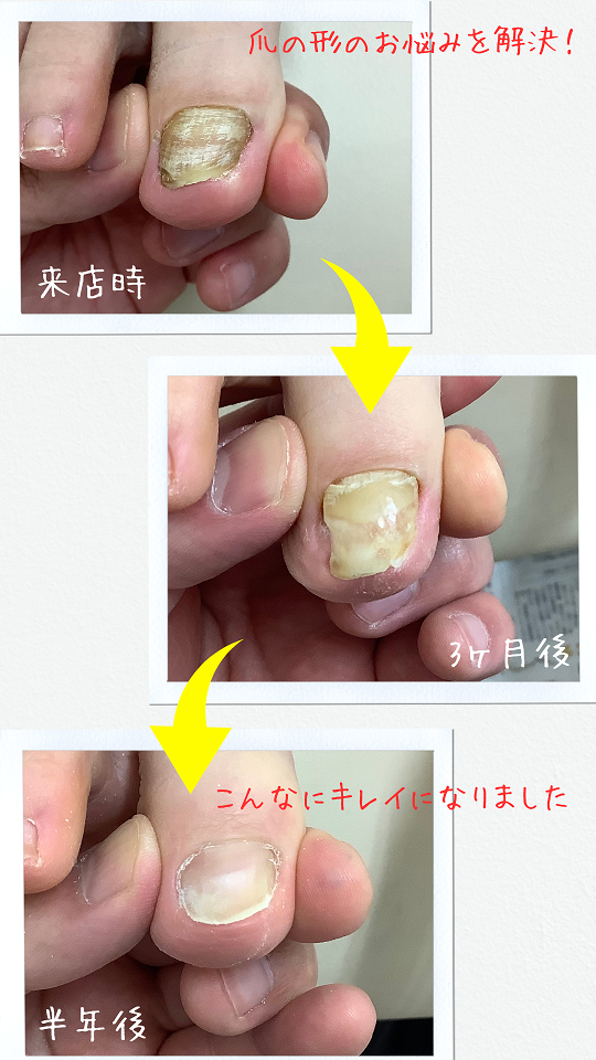 爪の変形の改善例-福井県ひまわり整骨院