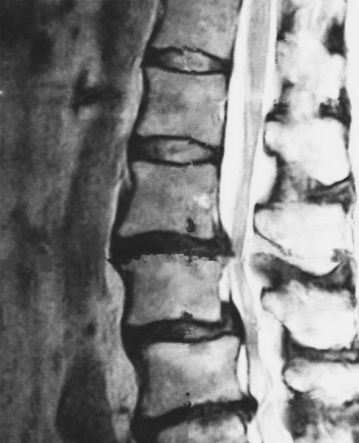 脊柱管狭窄症のMRI画像