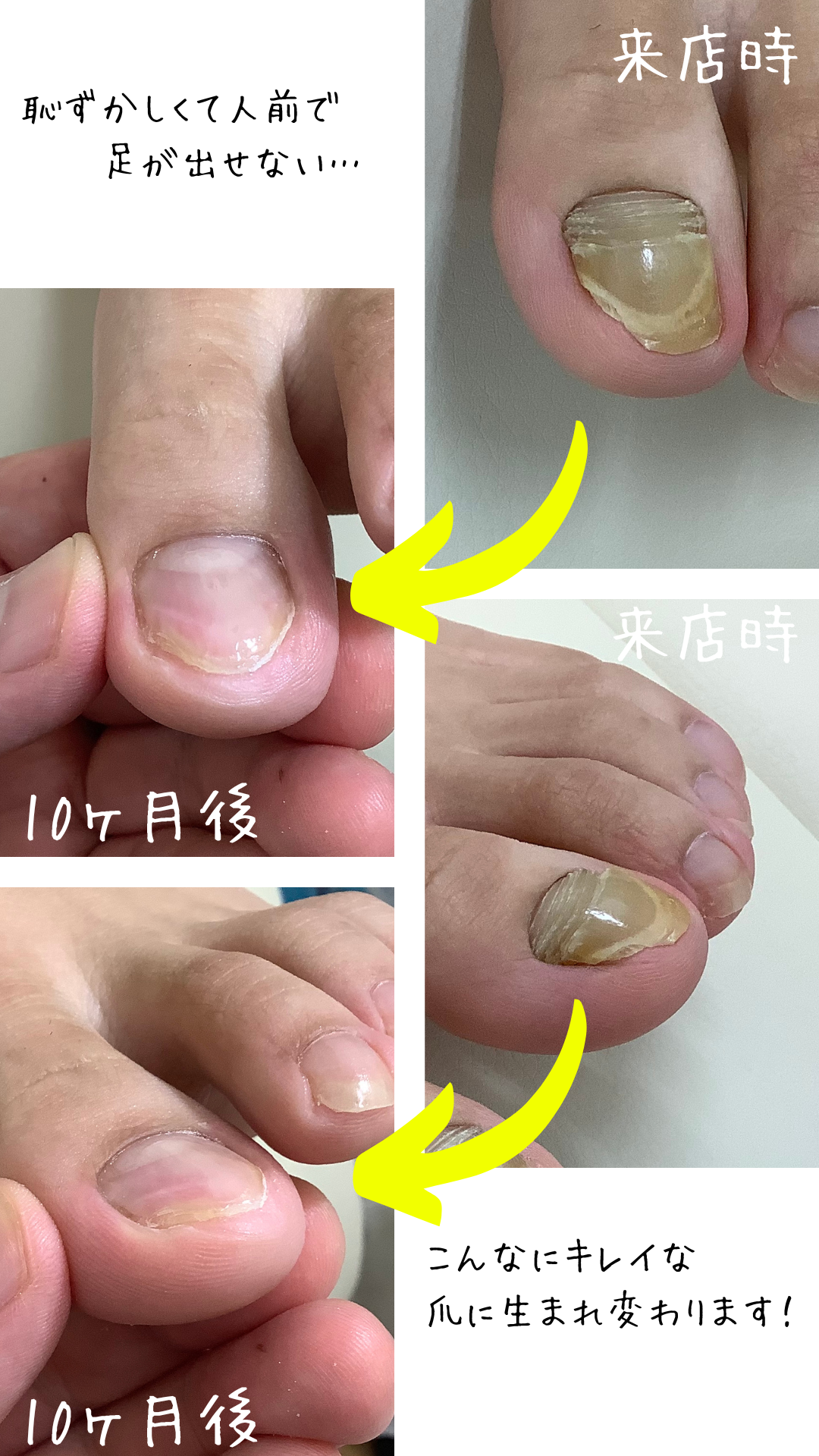 爪の変形の改善例-福井県ひまわり整骨院