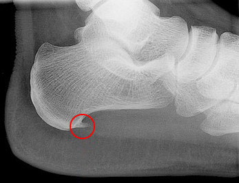 足底腱膜炎のレントゲン写真